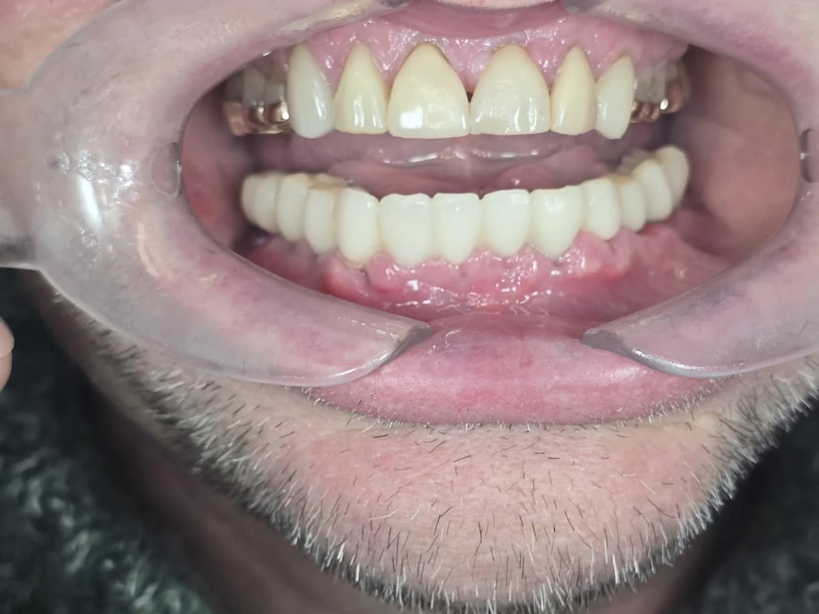 Dental Implants