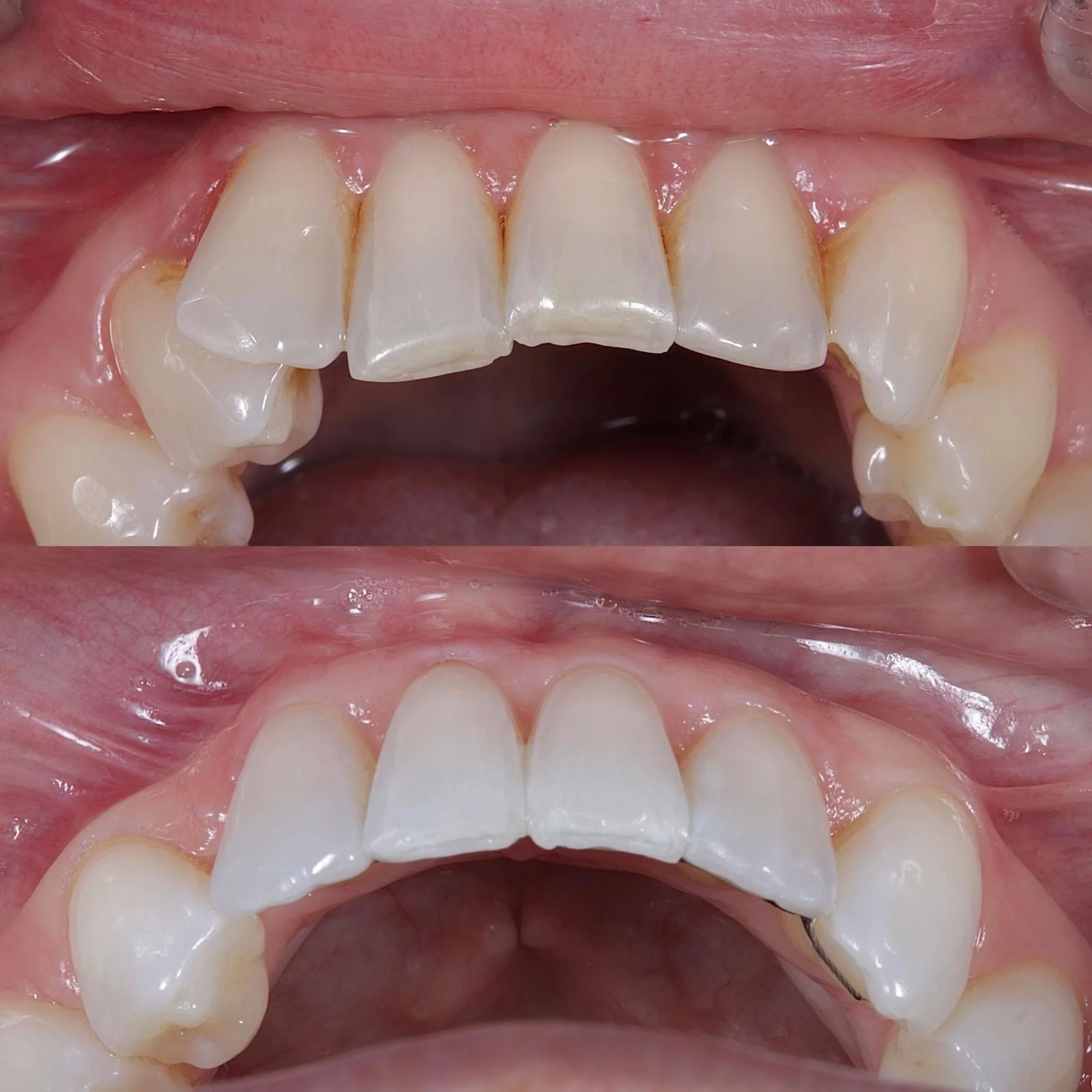 Edge Bonding Restoration - Before and After