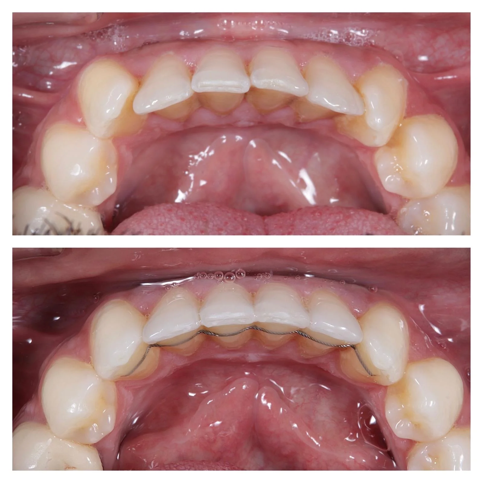 Invisalign Transformation - Before and After