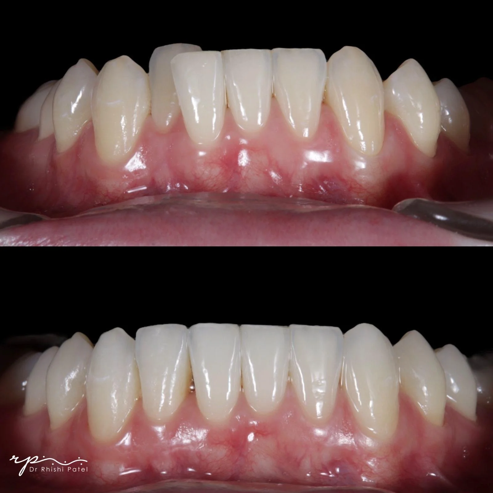 Lower Arch Enhancement - Before and After