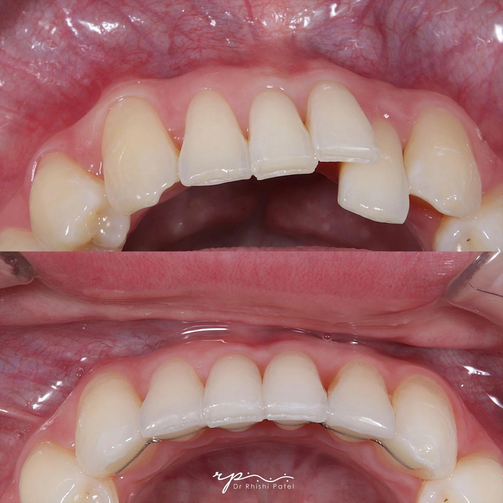 Chipped Tooth Repair - Before and After