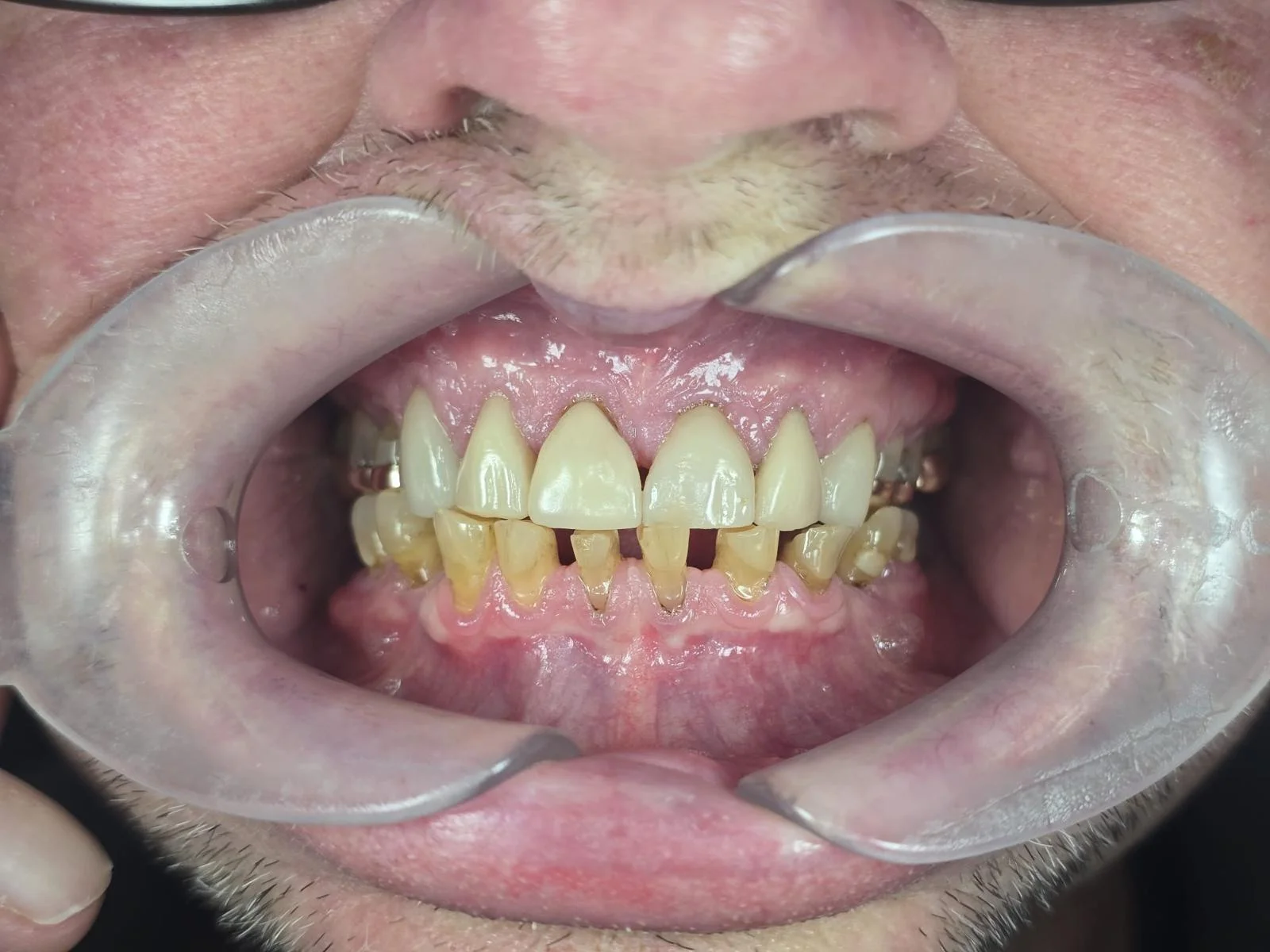 Same-Day Dental Implants & Bridge - Before