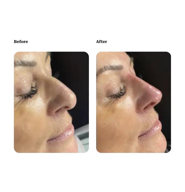 Nose reshaping